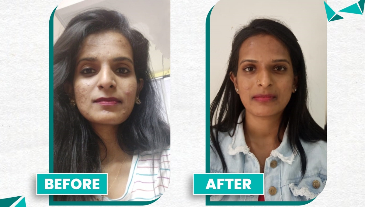 Acne Scar Treatment in Bangalore