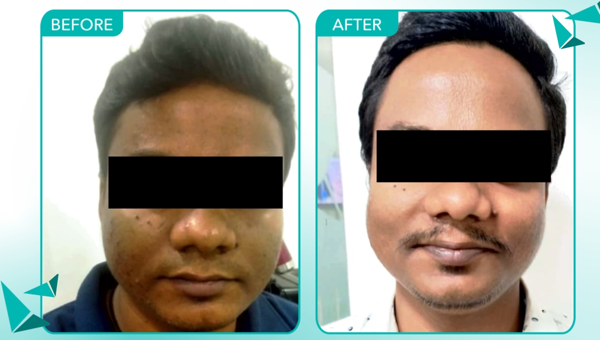 Acne Scar Treatment in Hyderabad
