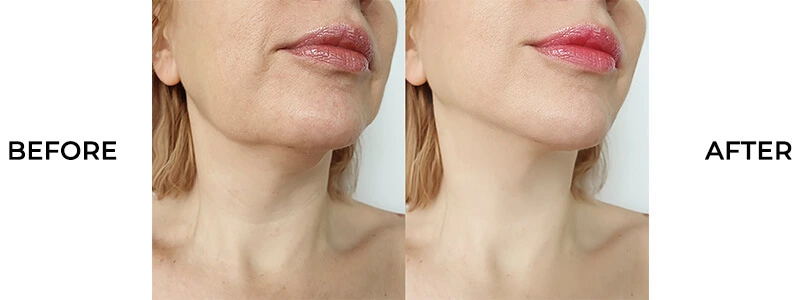 Double Chin Treatment in Bangalore