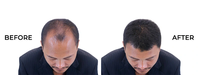 Before and After Hair Transplantation Hyderabad