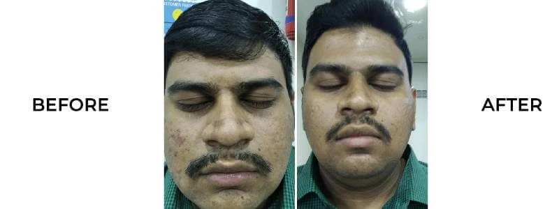 Before and After Open Pores Treatment