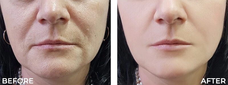 Before and After Skin Rejuvenation