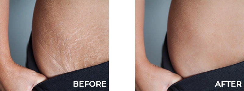 Before and After Stretch Mark Treatment