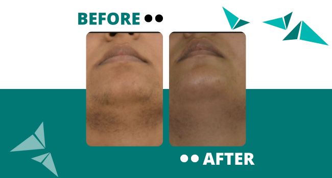 Before and After