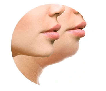 Double Chin Treatment in Hyderabad