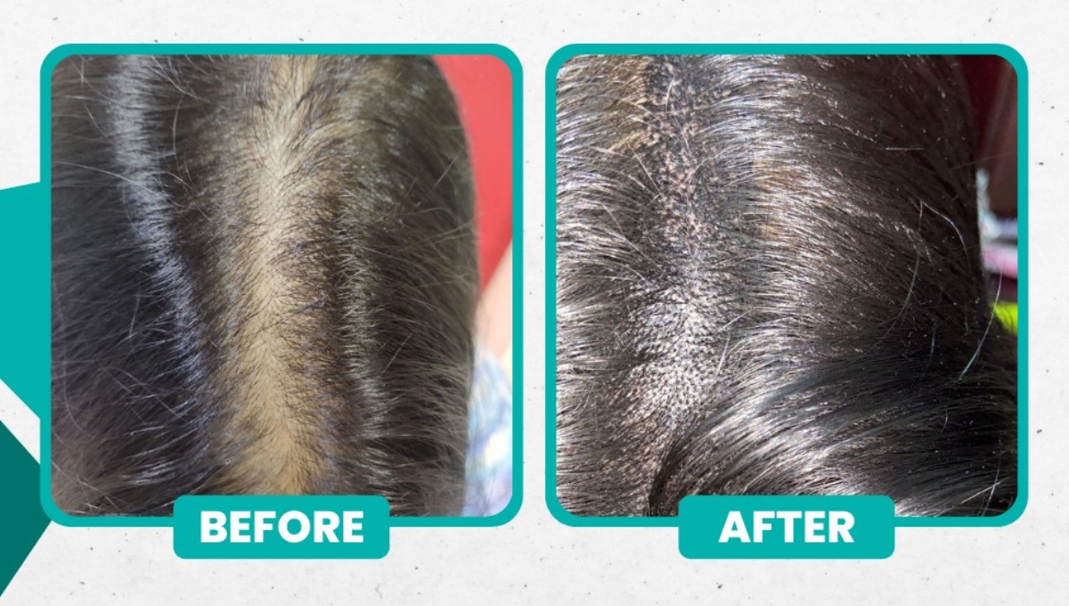 Before and After Hair Loss Treatment