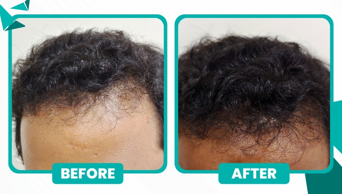 Before and After Hair Transplantation Bangalore