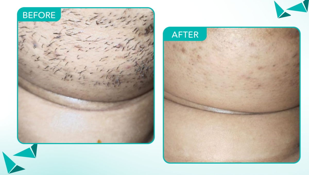 Before and After Permanent Hair Removal