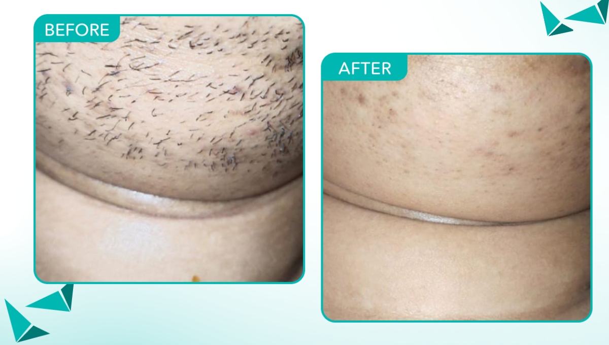 Before and After Laser Hair Removal in Hyderabad