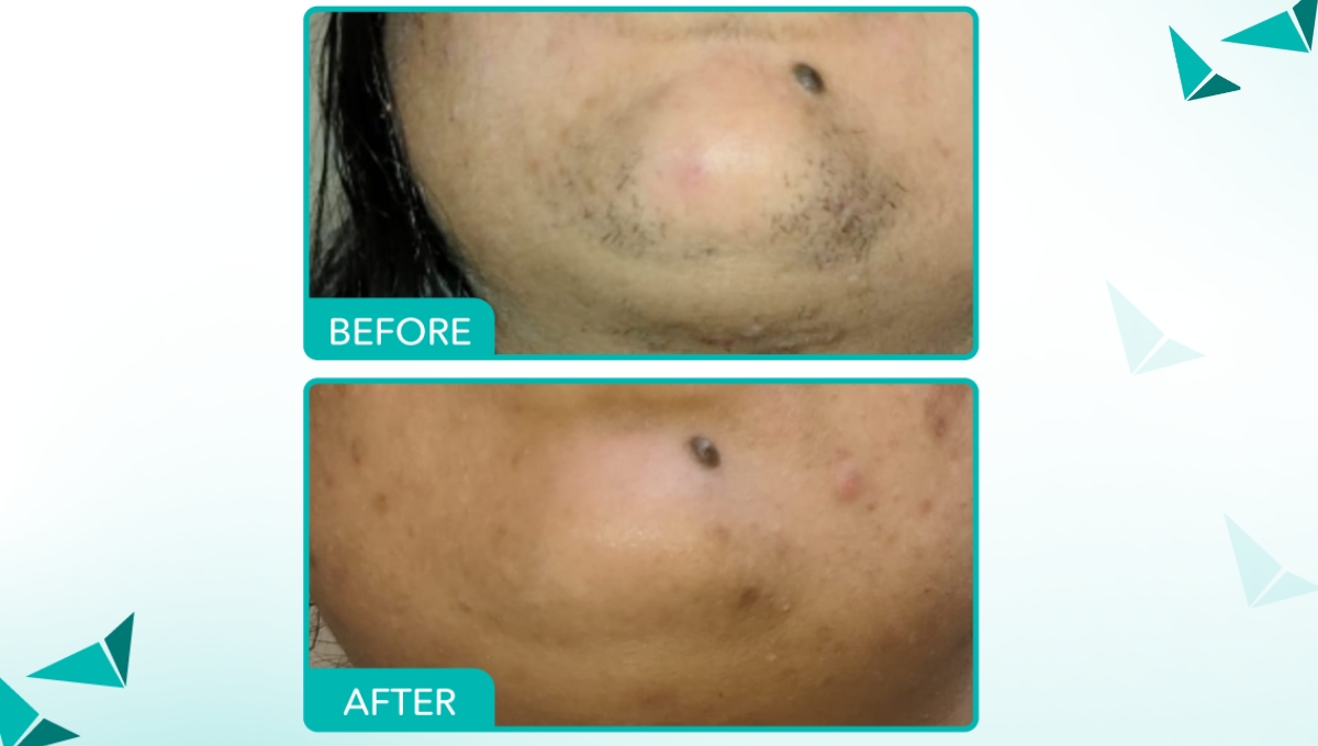 Laser hair removal in Vijayawada