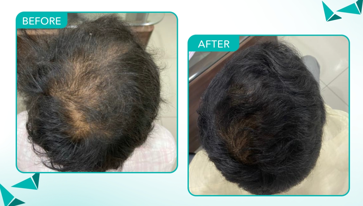 Before and After PRP Treatment