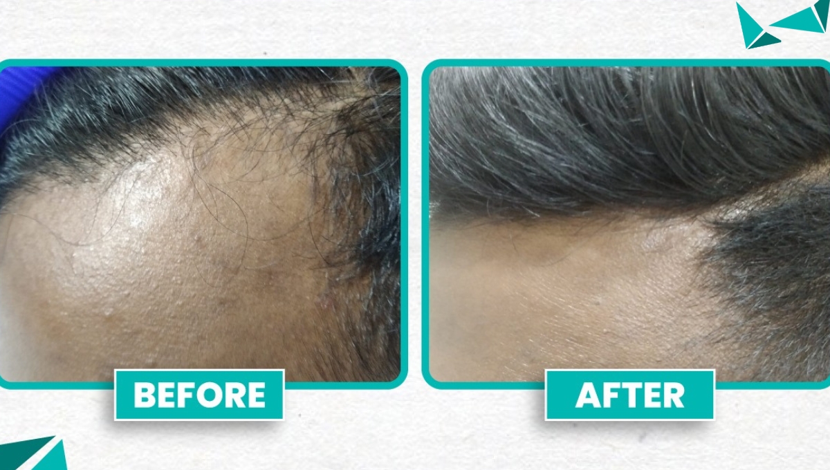 Before and After PRP Treatment