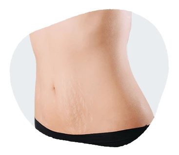 Stretch Marks Treatment in Hyderabad